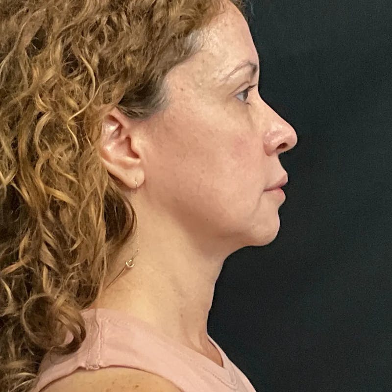Zoom Neck Lift Before & After Gallery - Patient 314720 - Image 3