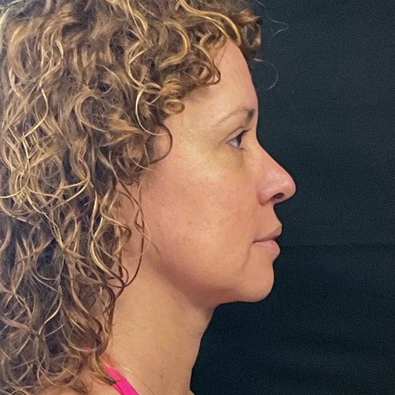 Zoom Neck Lift Before & After Gallery - Patient 314720 - Image 4