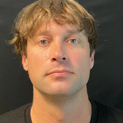 Zoom Neck Lift Before & After Gallery - Patient 241045 - Image 1