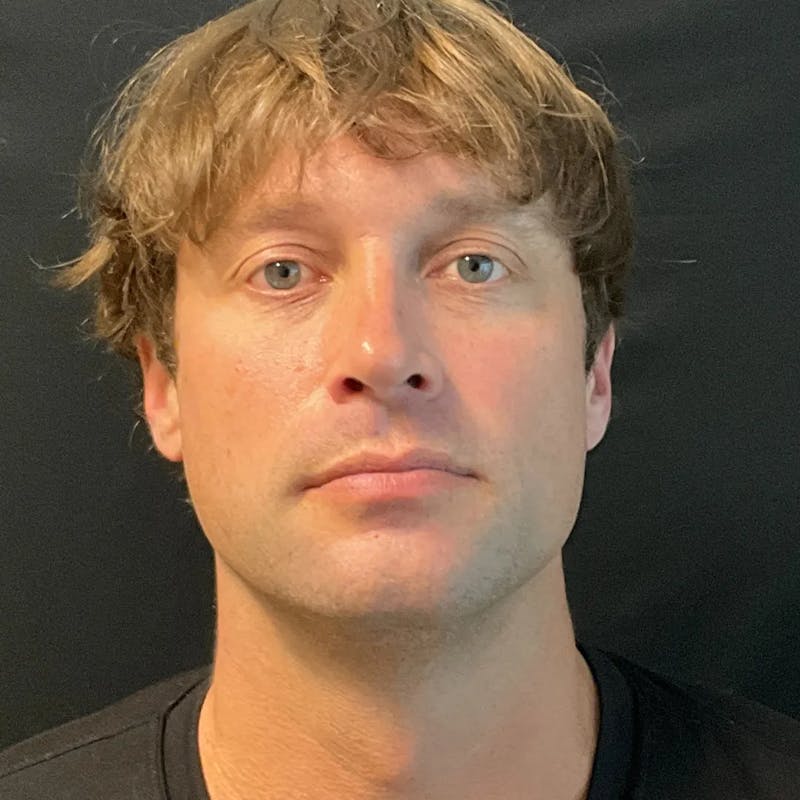 Zoom Neck Lift Before & After Gallery - Patient 241045 - Image 1