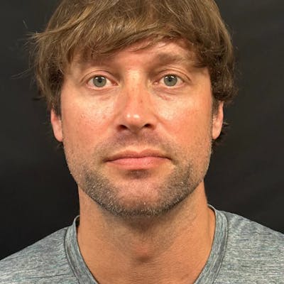 Zoom Neck Lift Before & After Gallery - Patient 241045 - Image 2
