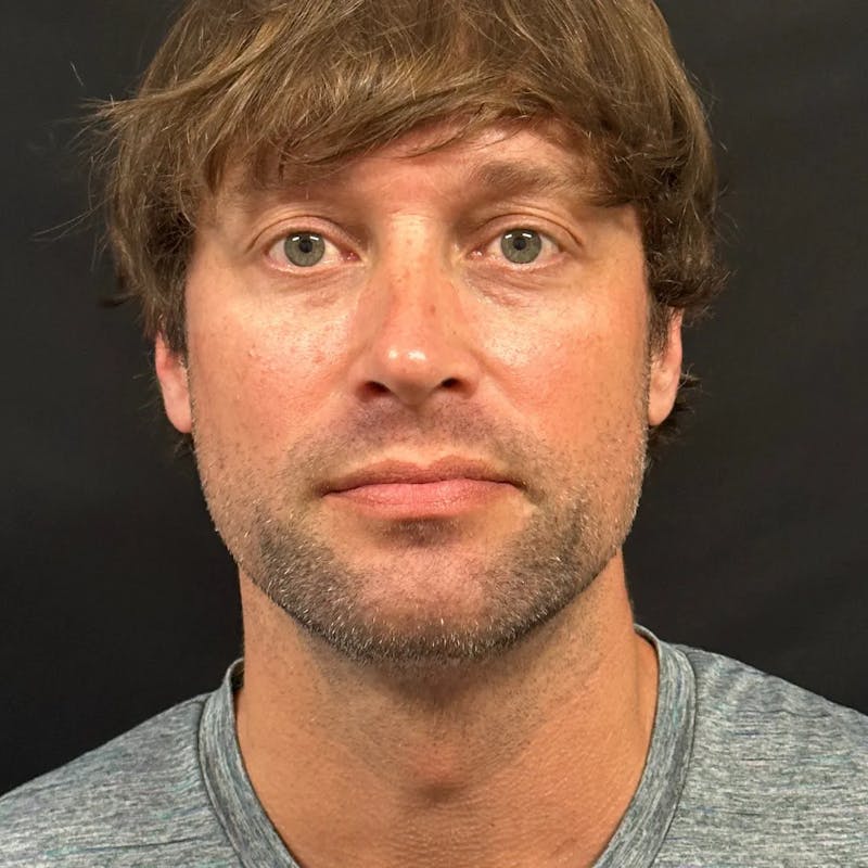 Zoom Neck Lift Before & After Gallery - Patient 241045 - Image 2