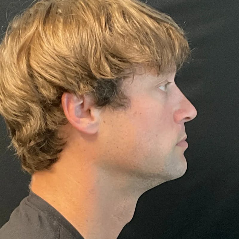 Zoom Neck Lift Before & After Gallery - Patient 241045 - Image 3
