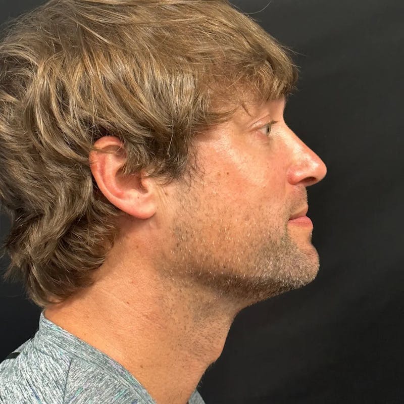 Zoom Neck Lift Before & After Gallery - Patient 241045 - Image 4