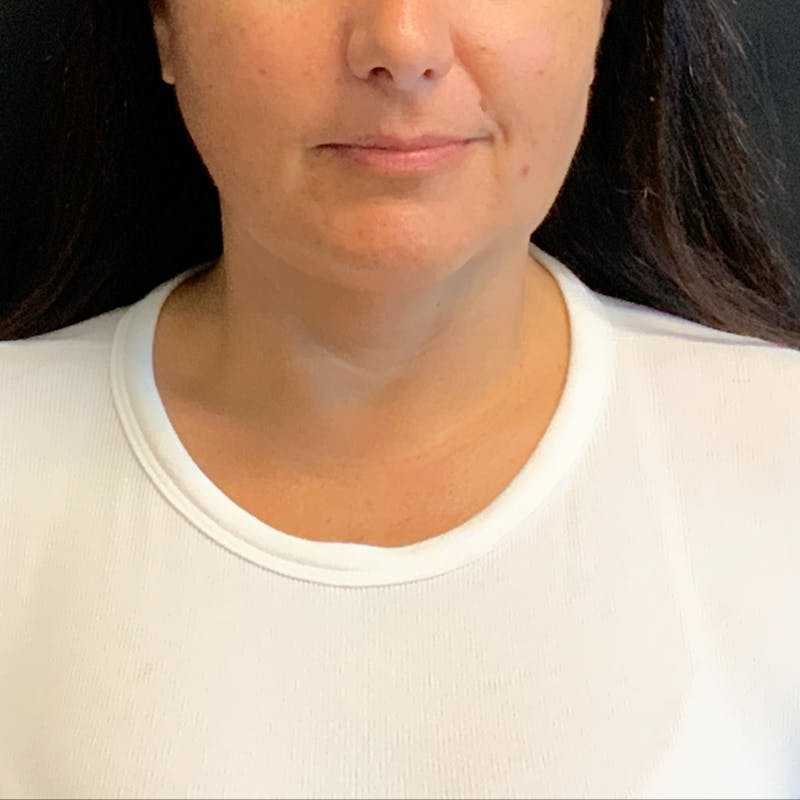 Jawline Contouring Before & After Gallery - Patient 254929 - Image 2