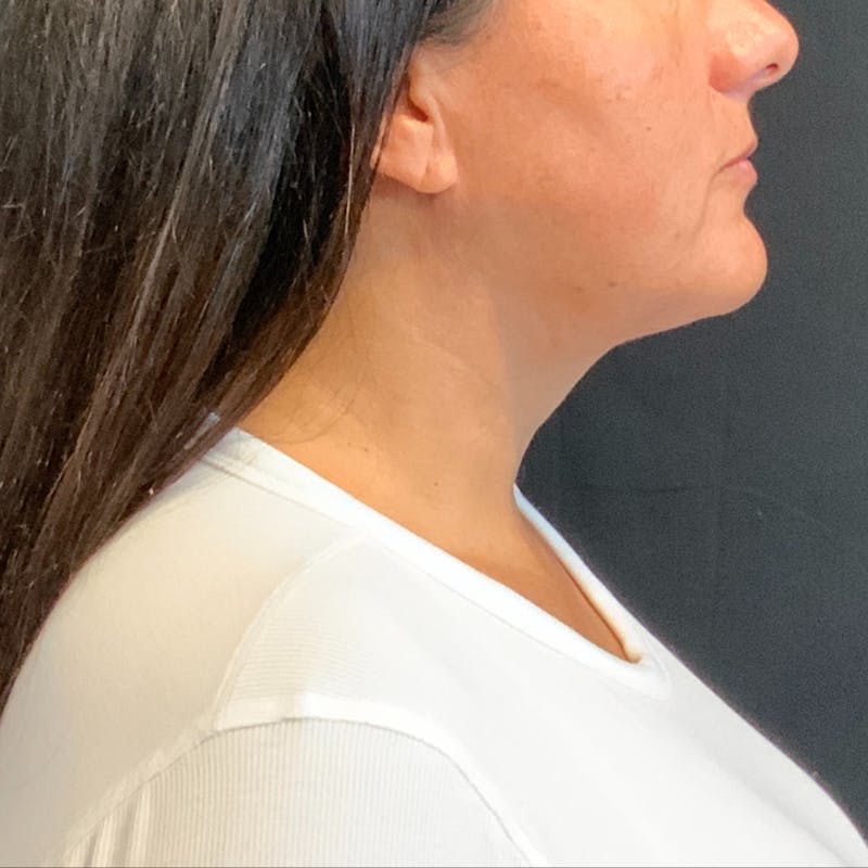 Jawline Contouring Before & After Gallery - Patient 254929 - Image 4
