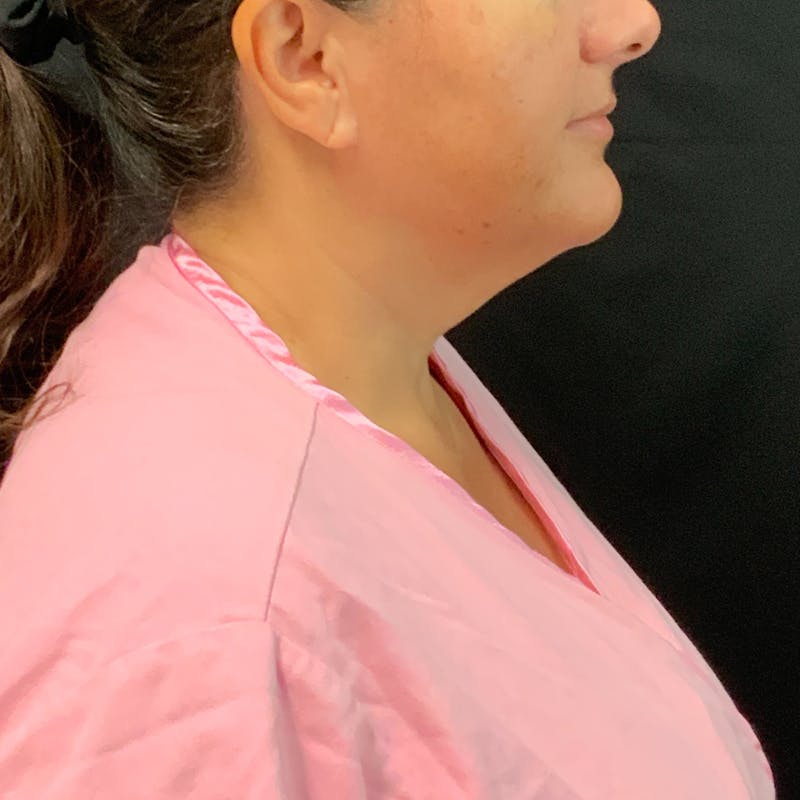 Jawline Contouring Before & After Gallery - Patient 254929 - Image 3