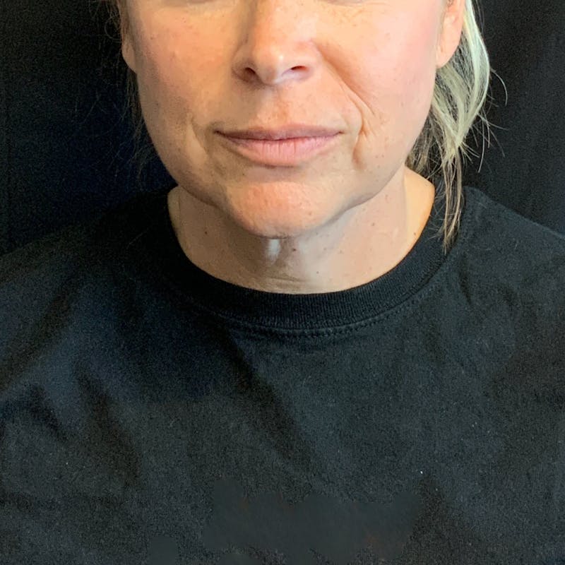 Jawline Contouring Before & After Gallery - Patient 245488 - Image 2