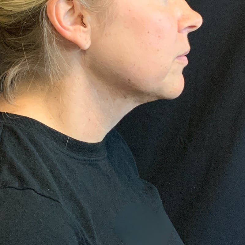 Jawline Contouring Before & After Gallery - Patient 245488 - Image 4