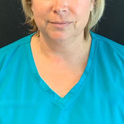 Jawline Contouring Before & After Gallery - Patient 245488 - Image 1