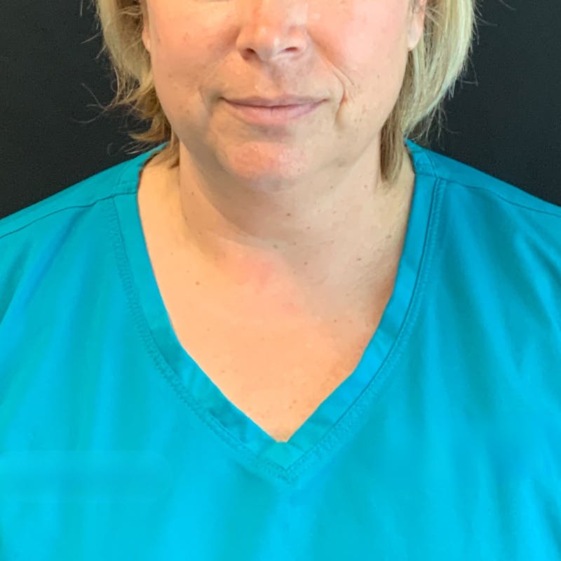 Jawline Contouring Before & After Gallery - Patient 245488 - Image 1
