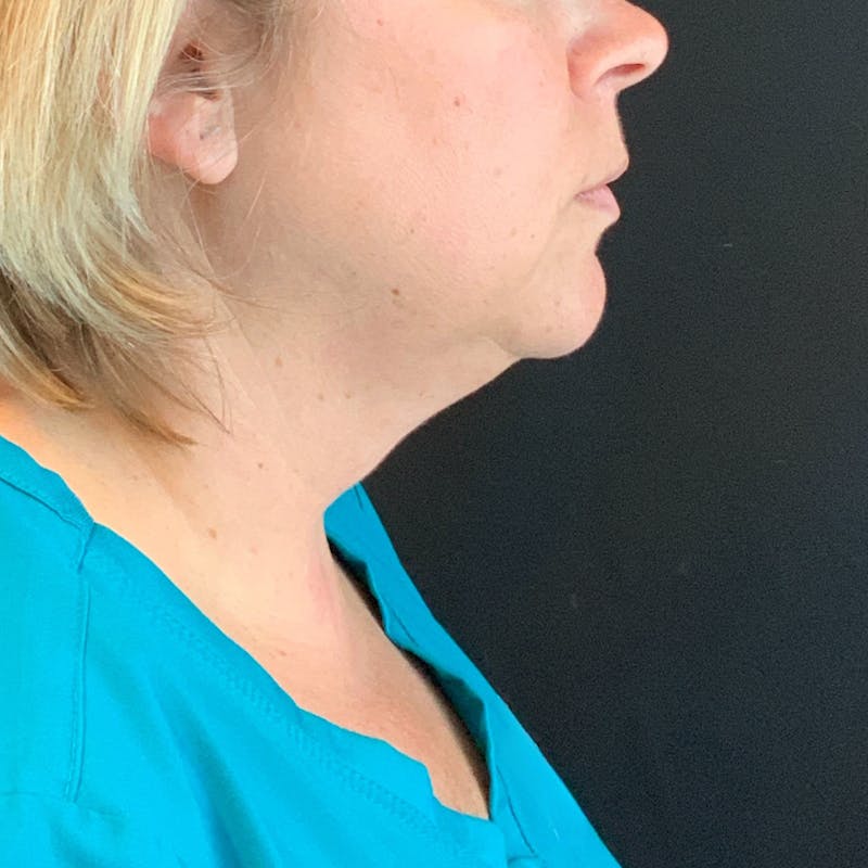 Jawline Contouring Before & After Gallery - Patient 245488 - Image 3