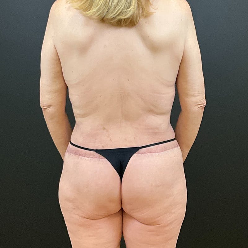 Body Lift Before & After Gallery - Patient 320377 - Image 6