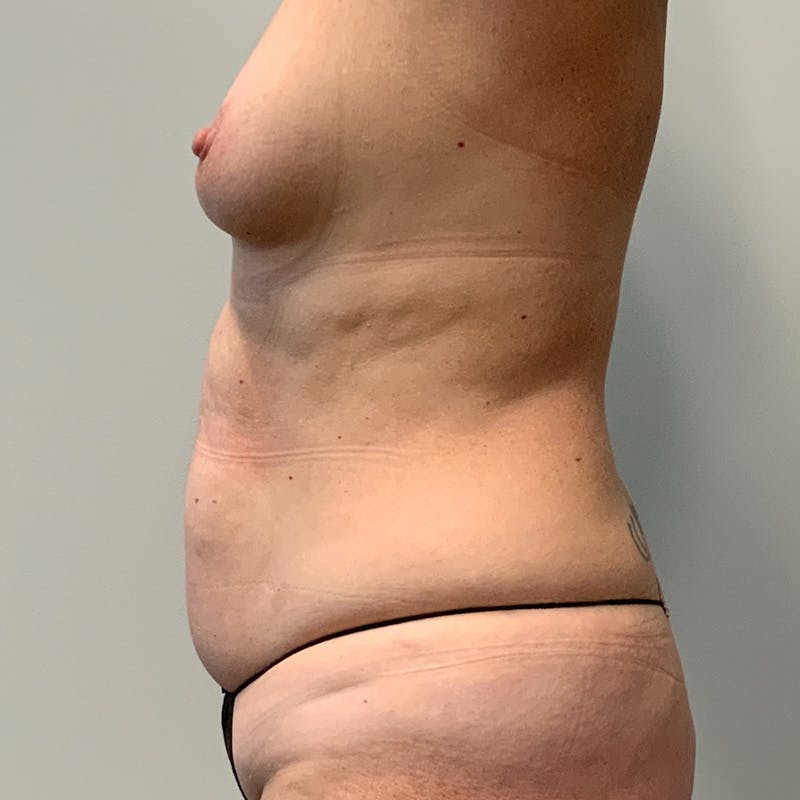 Body Lift Before & After Gallery - Patient 337217 - Image 3