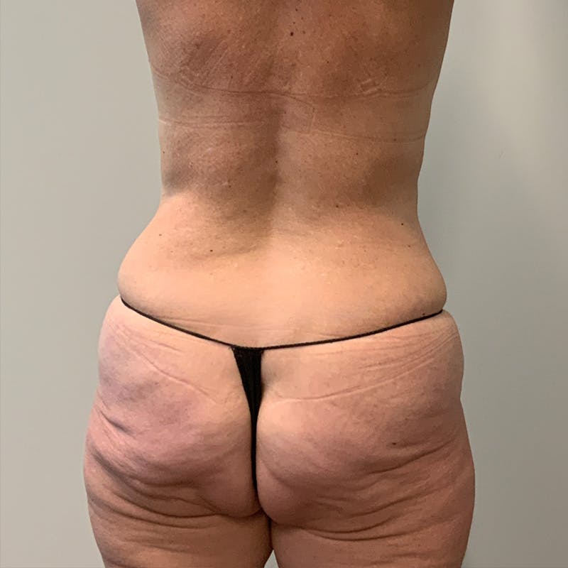 Body Lift Before & After Gallery - Patient 337217 - Image 5
