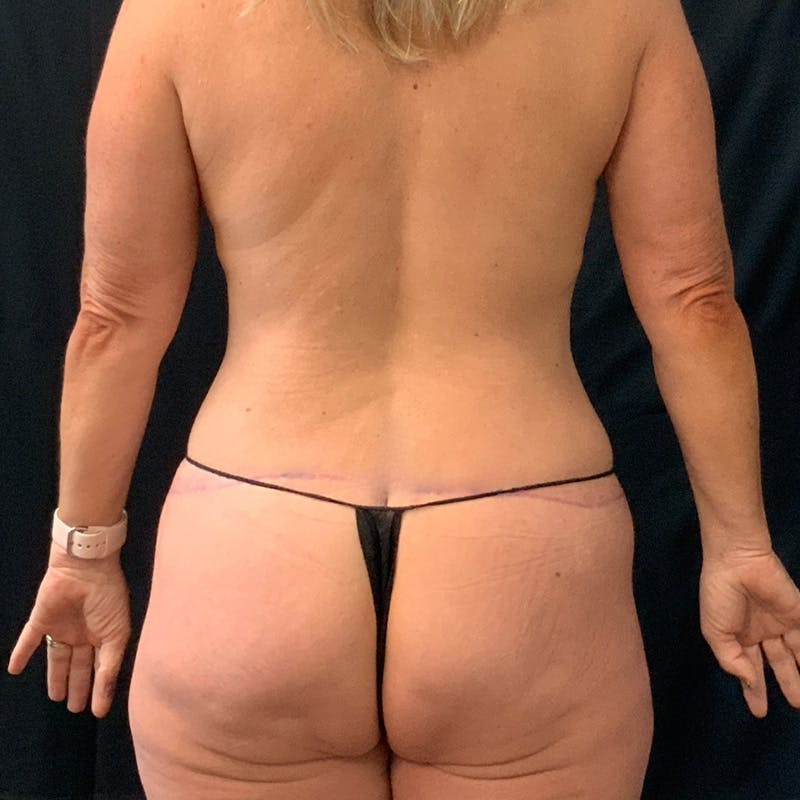 Body Lift Before & After Gallery - Patient 337217 - Image 6