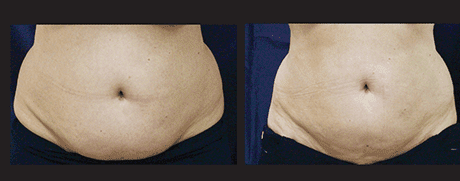 Before and after image of SculpSure