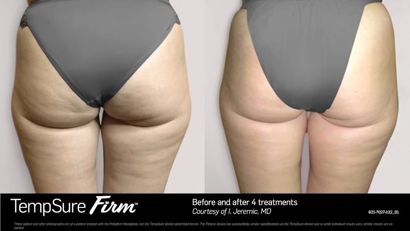 before and after Tempsure treatment