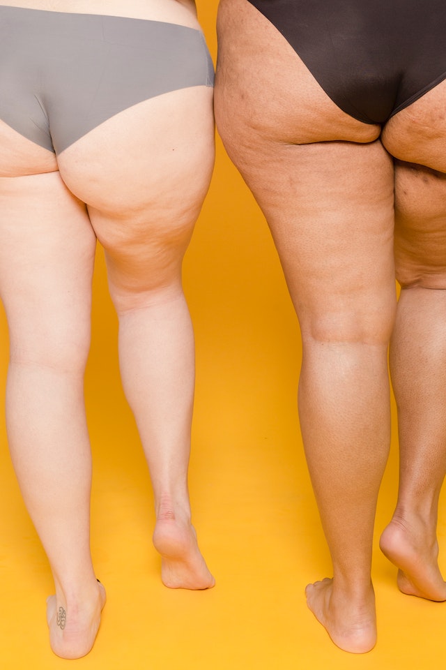two women with cellulite