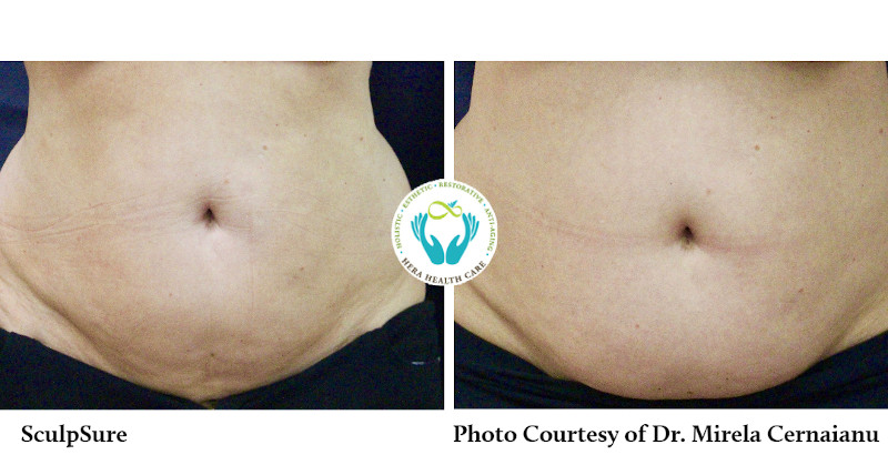 Sculpsure Treatment in Thousand Oaks