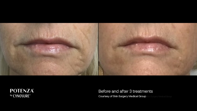 before and after of Potenza