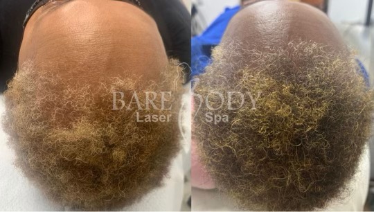 Hair Restoration with Fotona