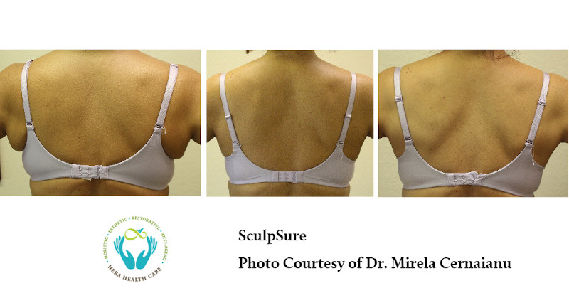 SculpSure before and After