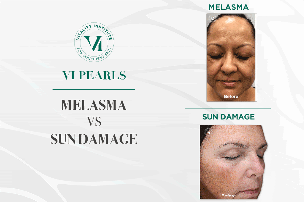 before and after gif of Melasma and sun damage treatments