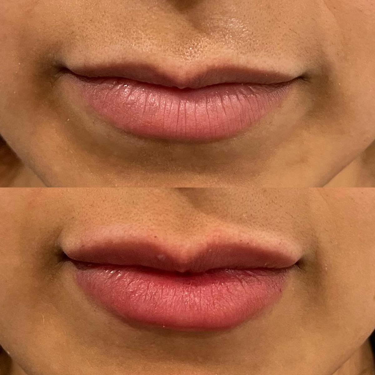 Lip Fillers Before & After Gallery - Patient 180396802 - Image 1