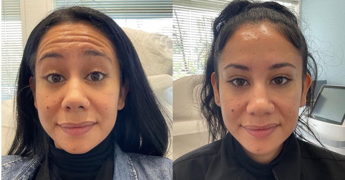 Wrinkle Relaxers Before & After Gallery - Patient 180396878 - Image 1