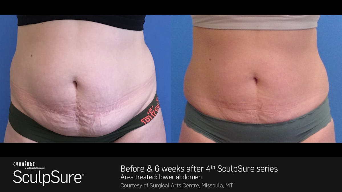 Sculpsure Before & After Gallery - Patient 180403402 - Image 1