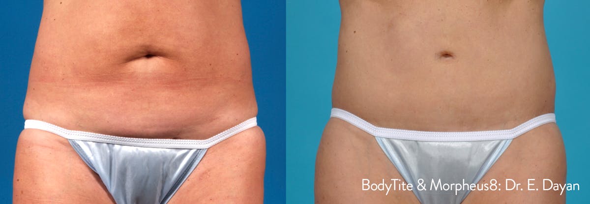 Morpheus8 Before & After Gallery - Patient 180403418 - Image 2