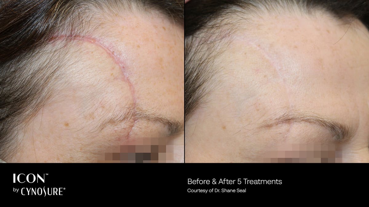 ICON™ Before & After Gallery - Patient 180415433 - Image 1