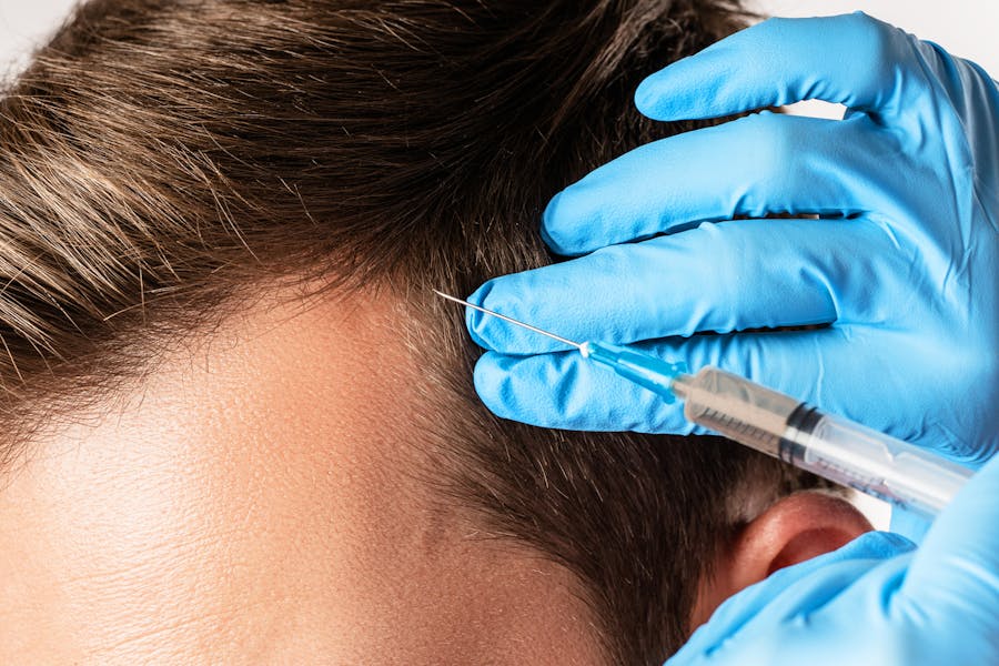 Man receiveing small painless injections on his scapl as a Exosome and PRP treatement for hairgrowth on his receding hairline