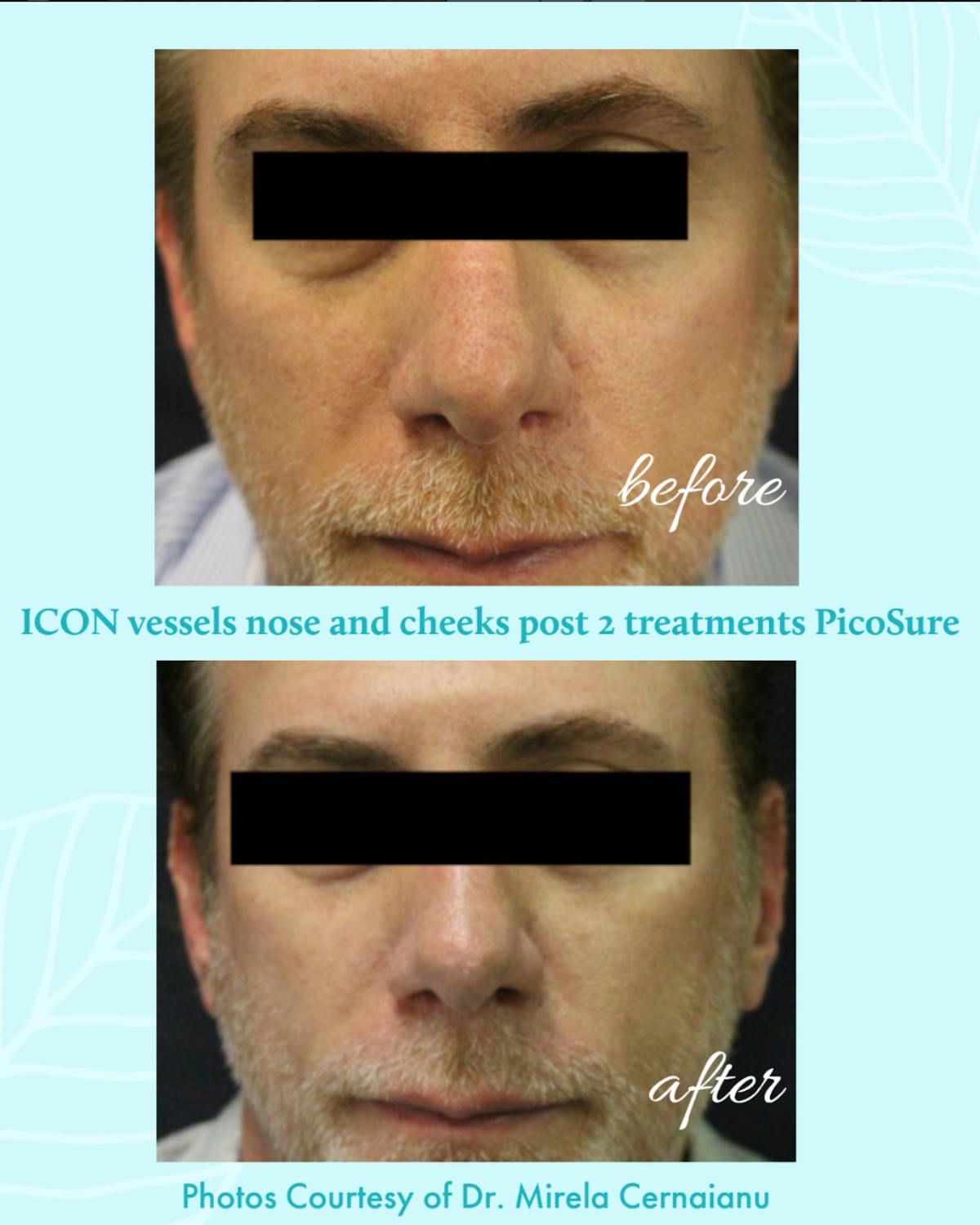 PicoSure Before & After Gallery - Patient 514841 - Image 1