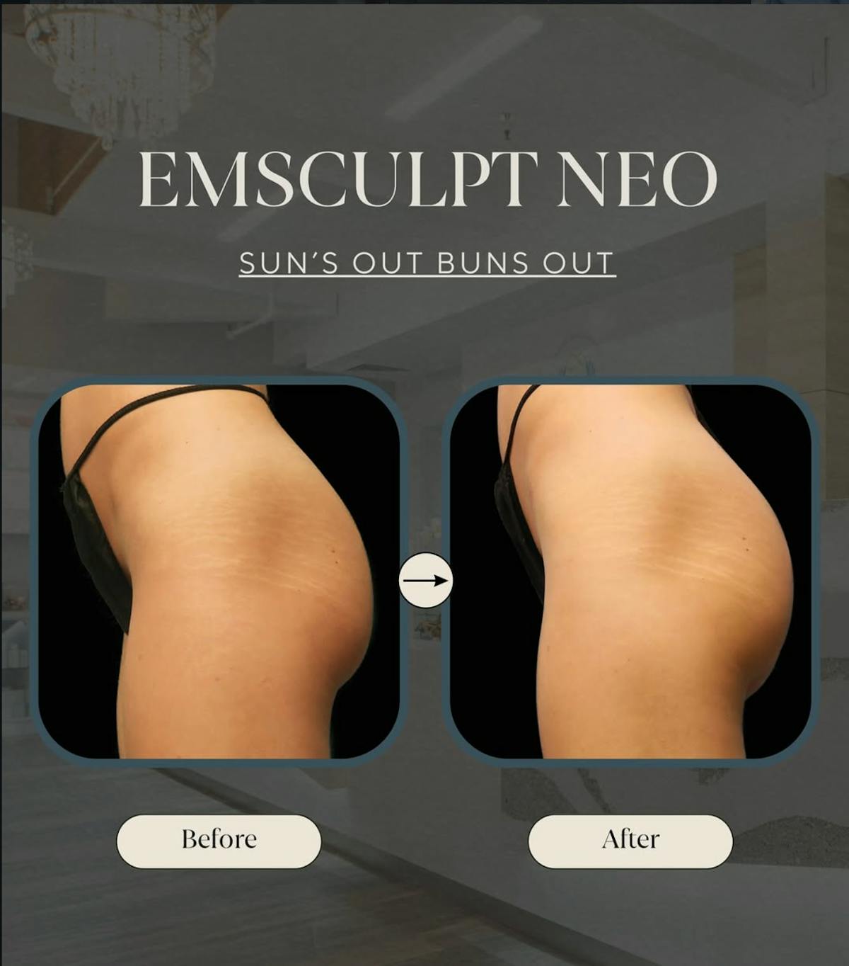 EmSculpt NEO Before & After Gallery - Patient 107748 - Image 1