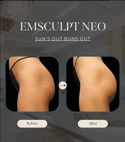 EmSculpt NEO Before & After Gallery - Patient 107748 - Image 1