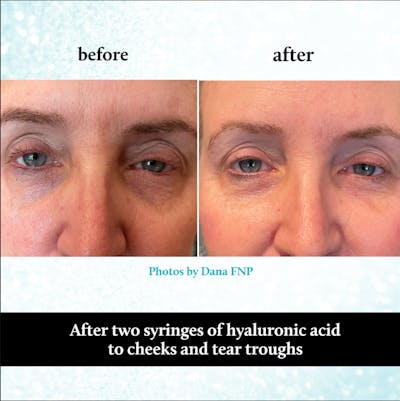 Tear Trough Fillers Before & After Gallery - Patient 296043 - Image 1