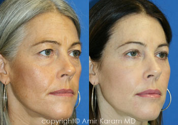 Vertical Restore With Fat Transfer