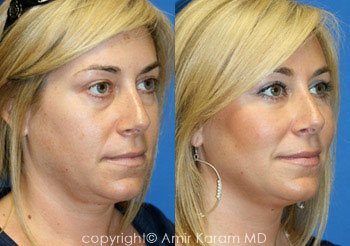 Vertical Restore With Fat Transfer