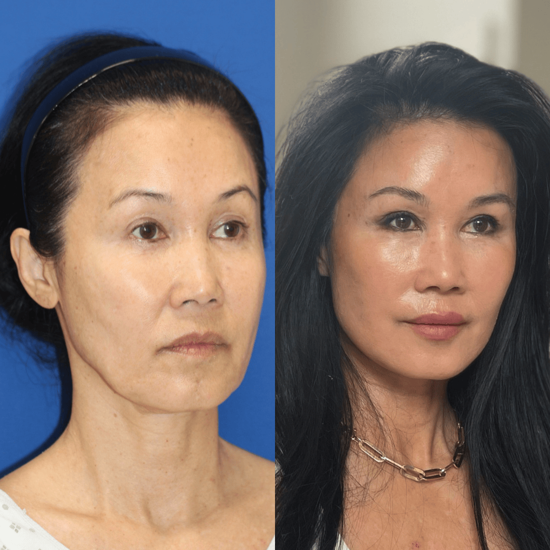 Jamie before and after Vertical Restore facelift and facial fat transfer