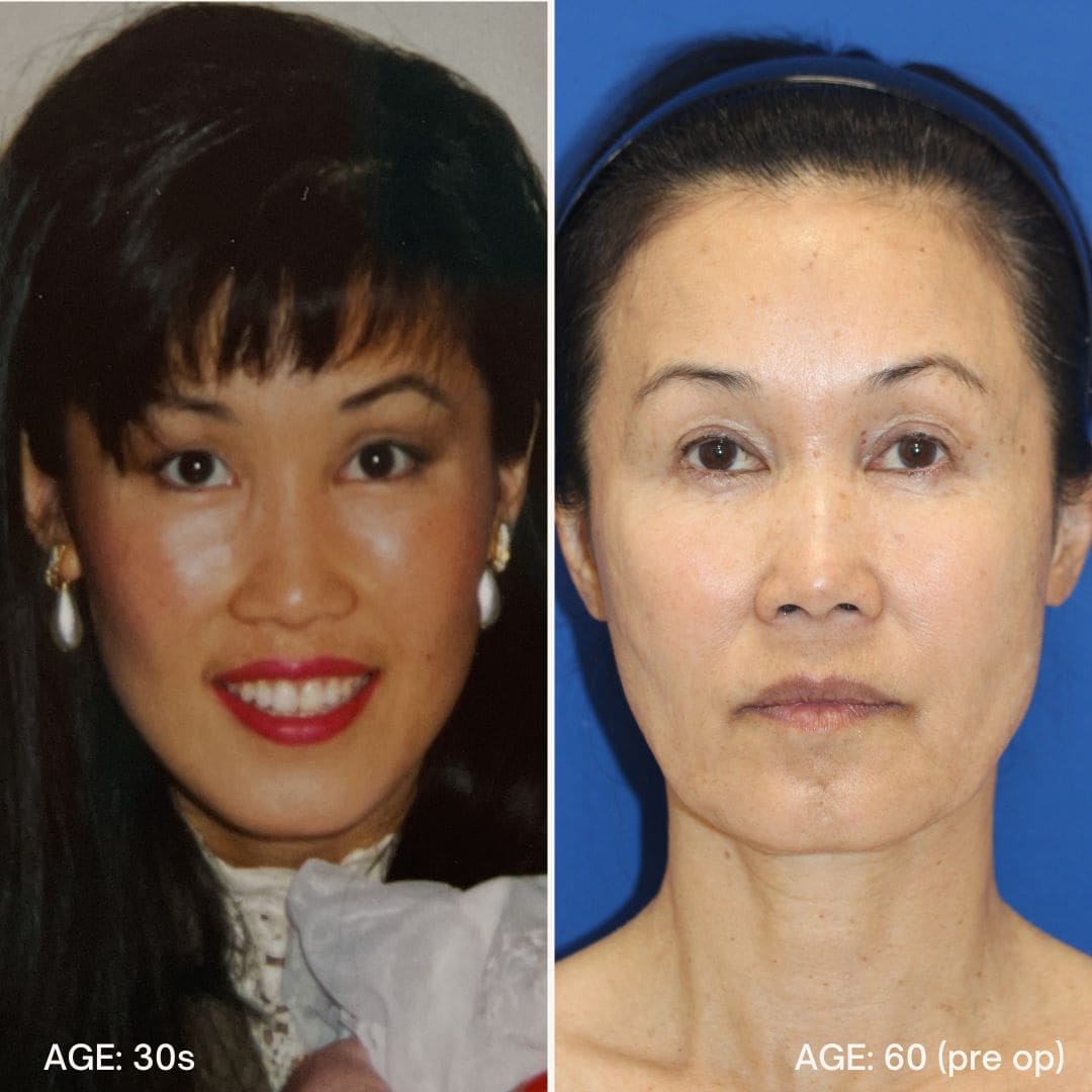 Jamie in her 30s before facial rejuvenation