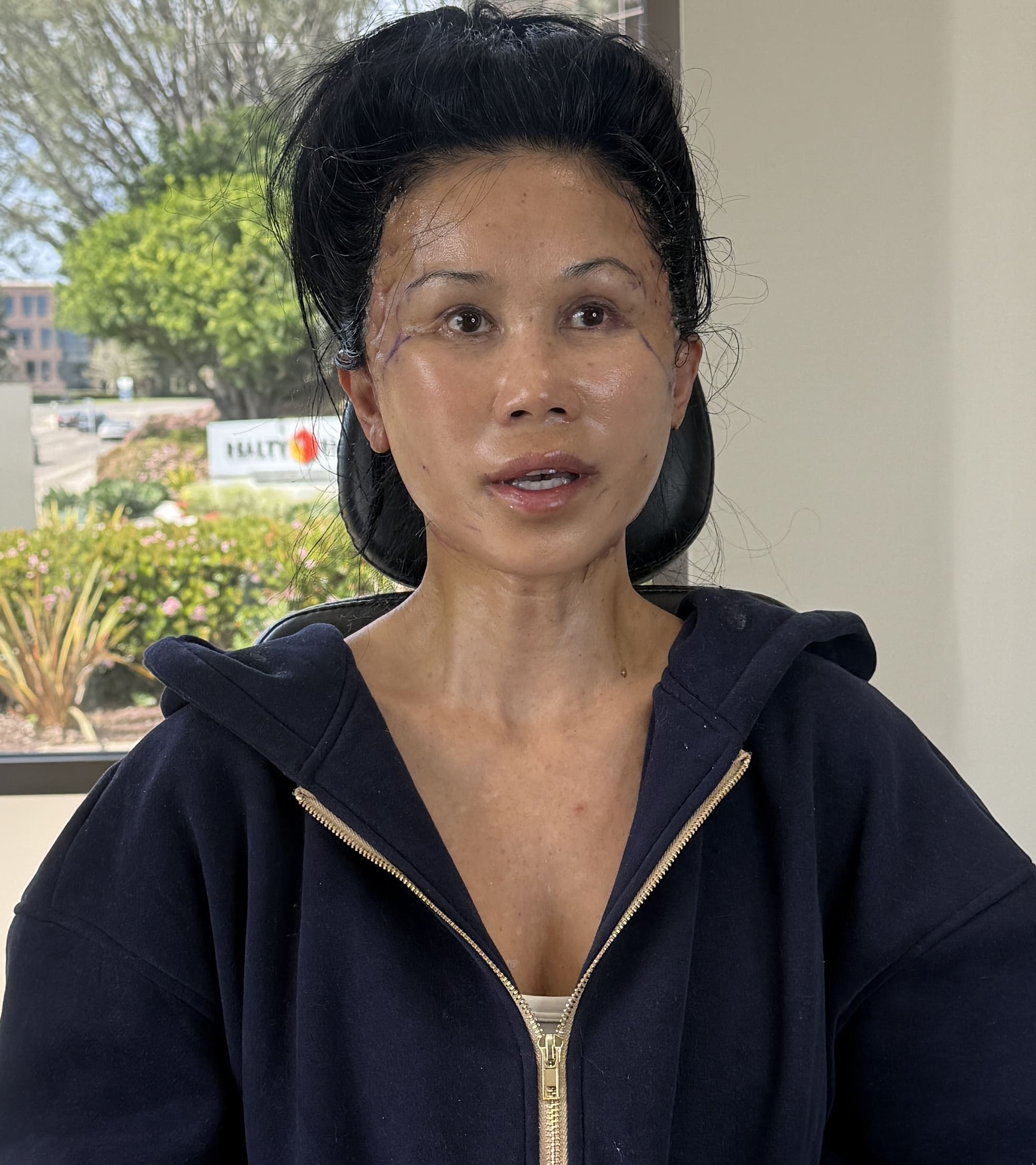 Jamie during her recovery following Vertical Restore facelift surgery