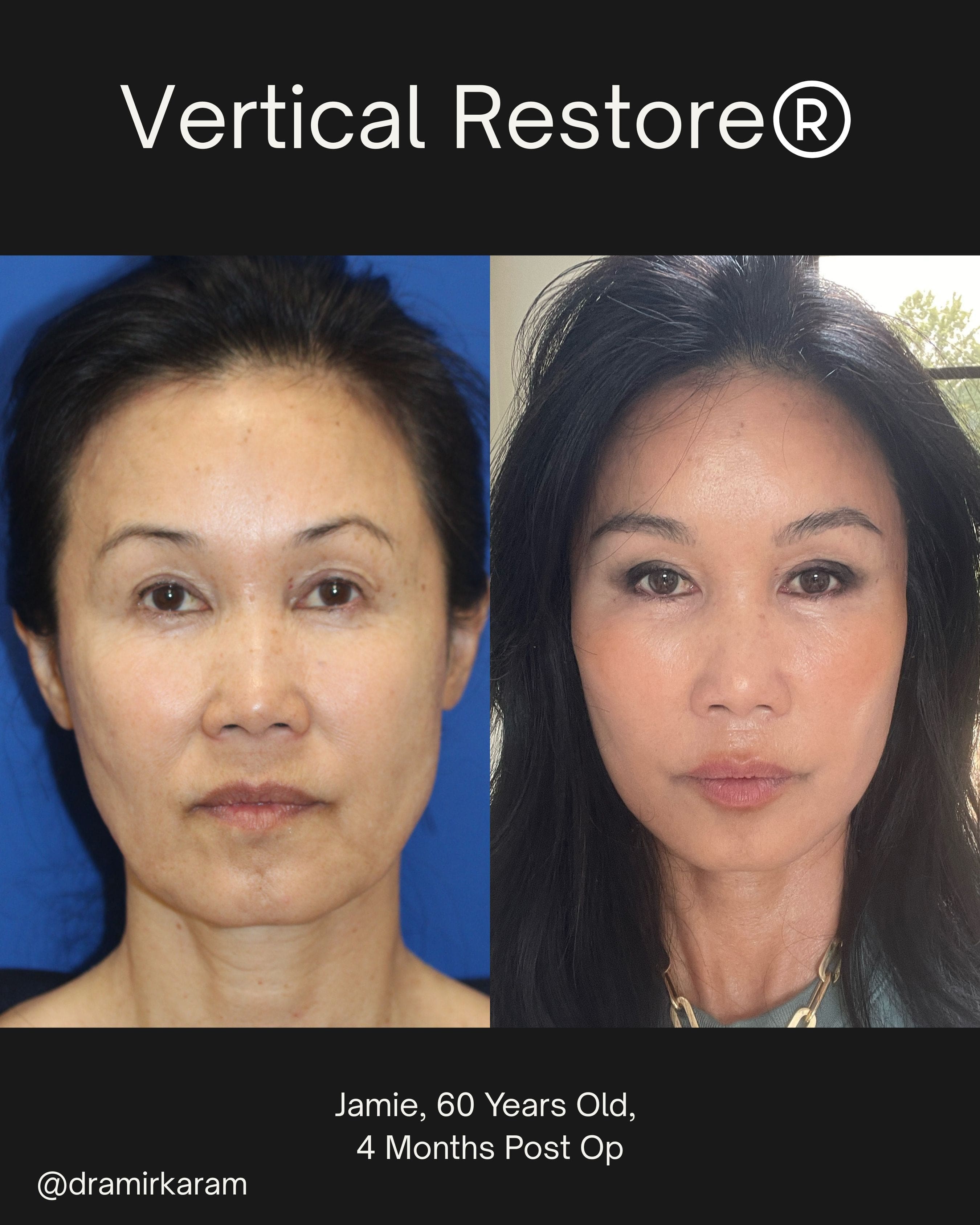 Jamie following her facial rejuvenation with Dr. Amir Karam