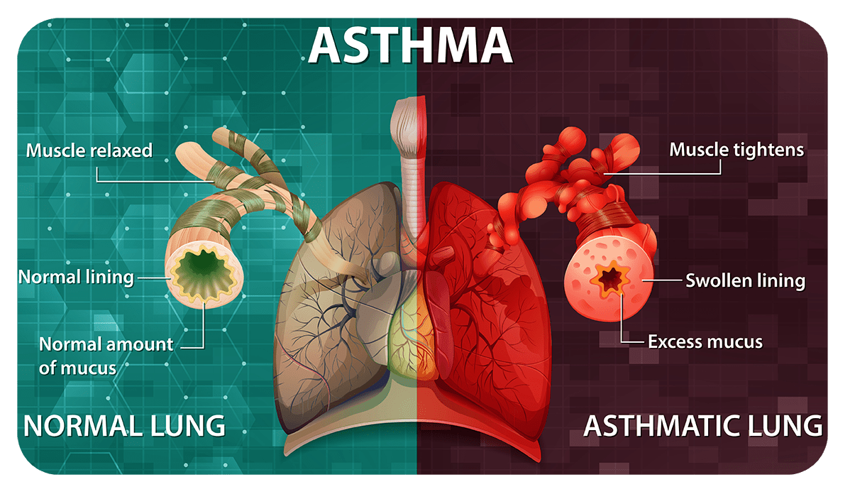 Asthma infographic