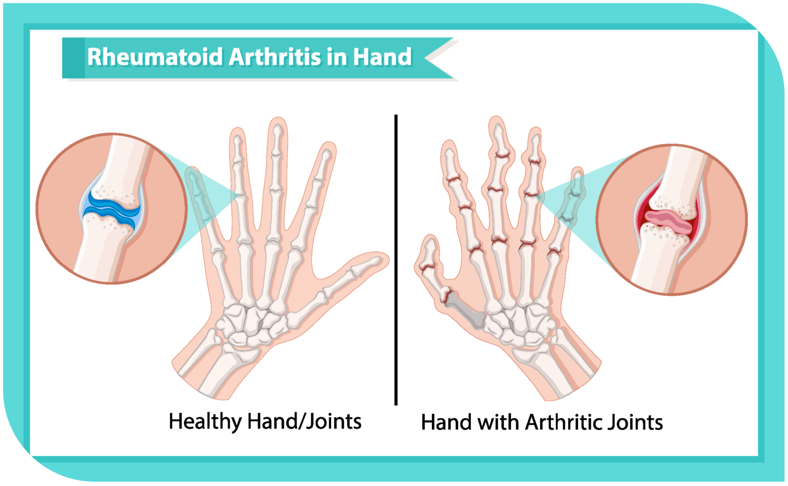 Rheumatoid Arthritis in hand infographic