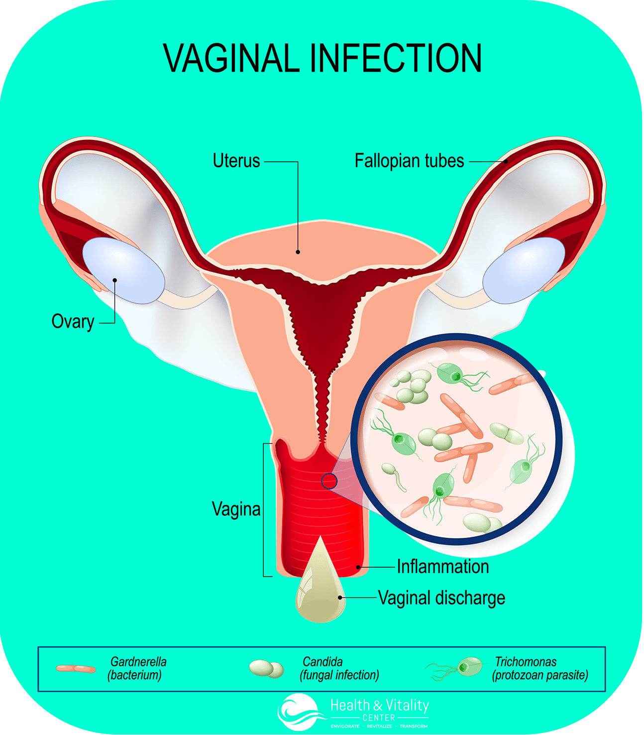 vaginal infection infographic