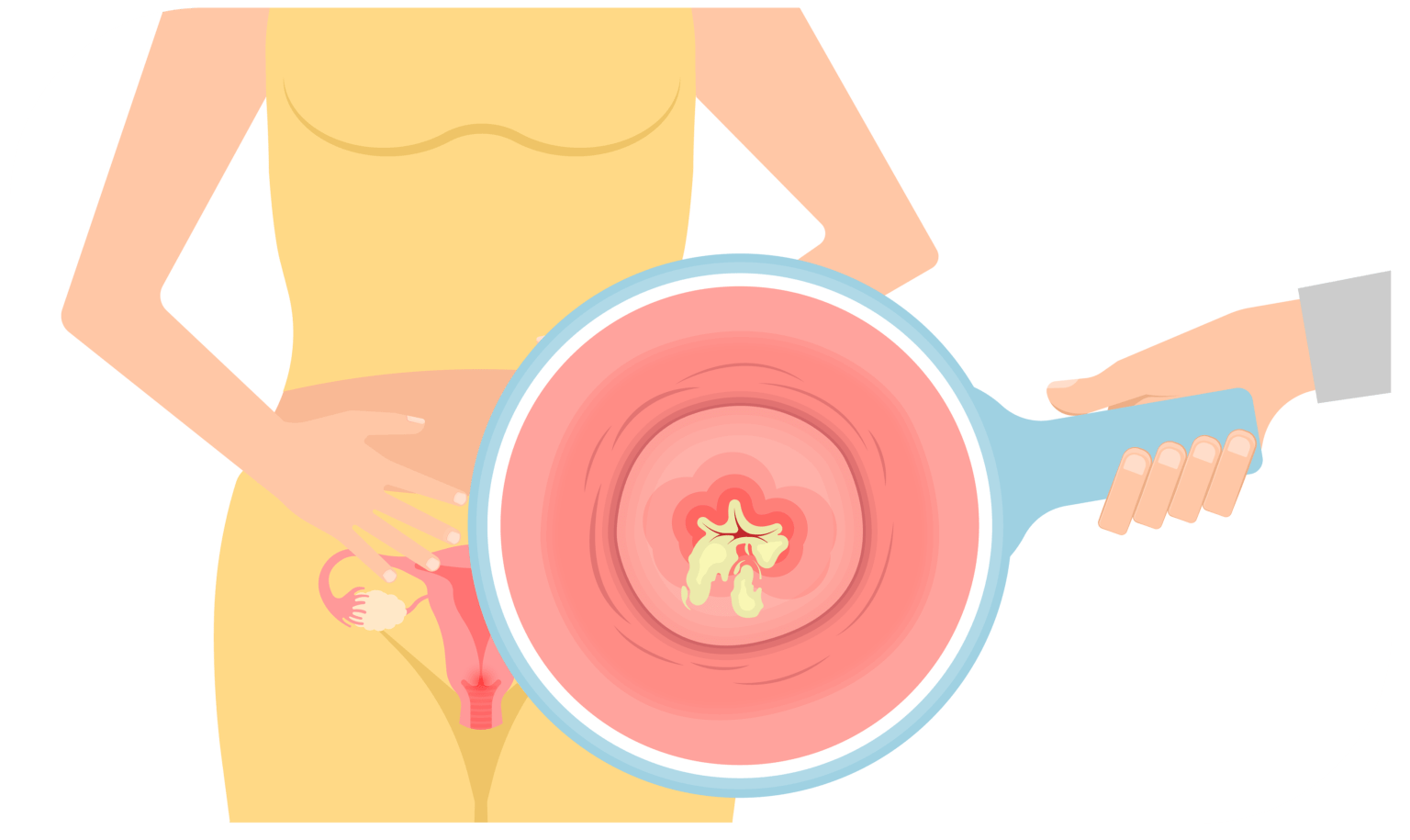 Yeast Infections graphic