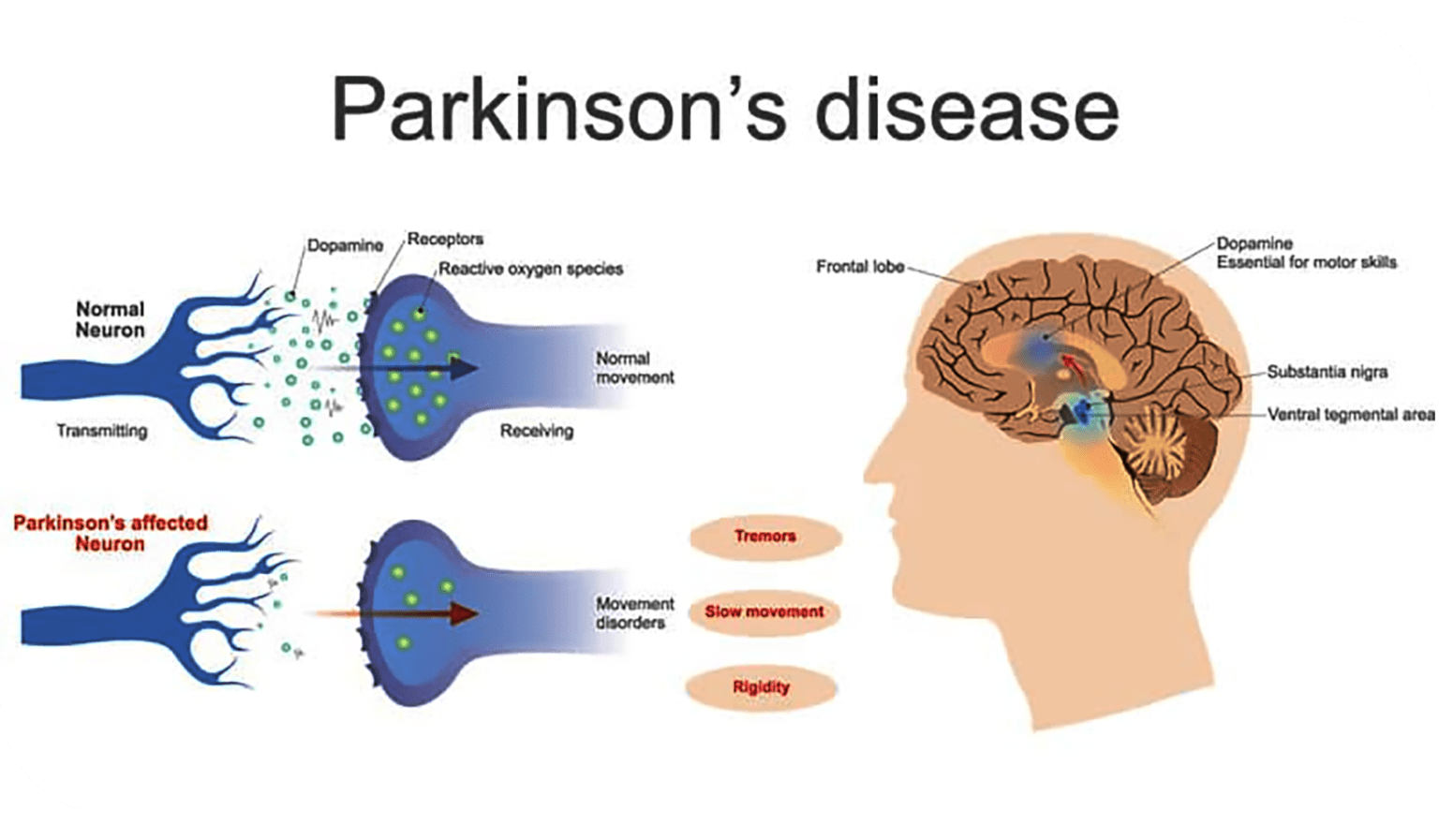 Parkinsons Disease infographic
