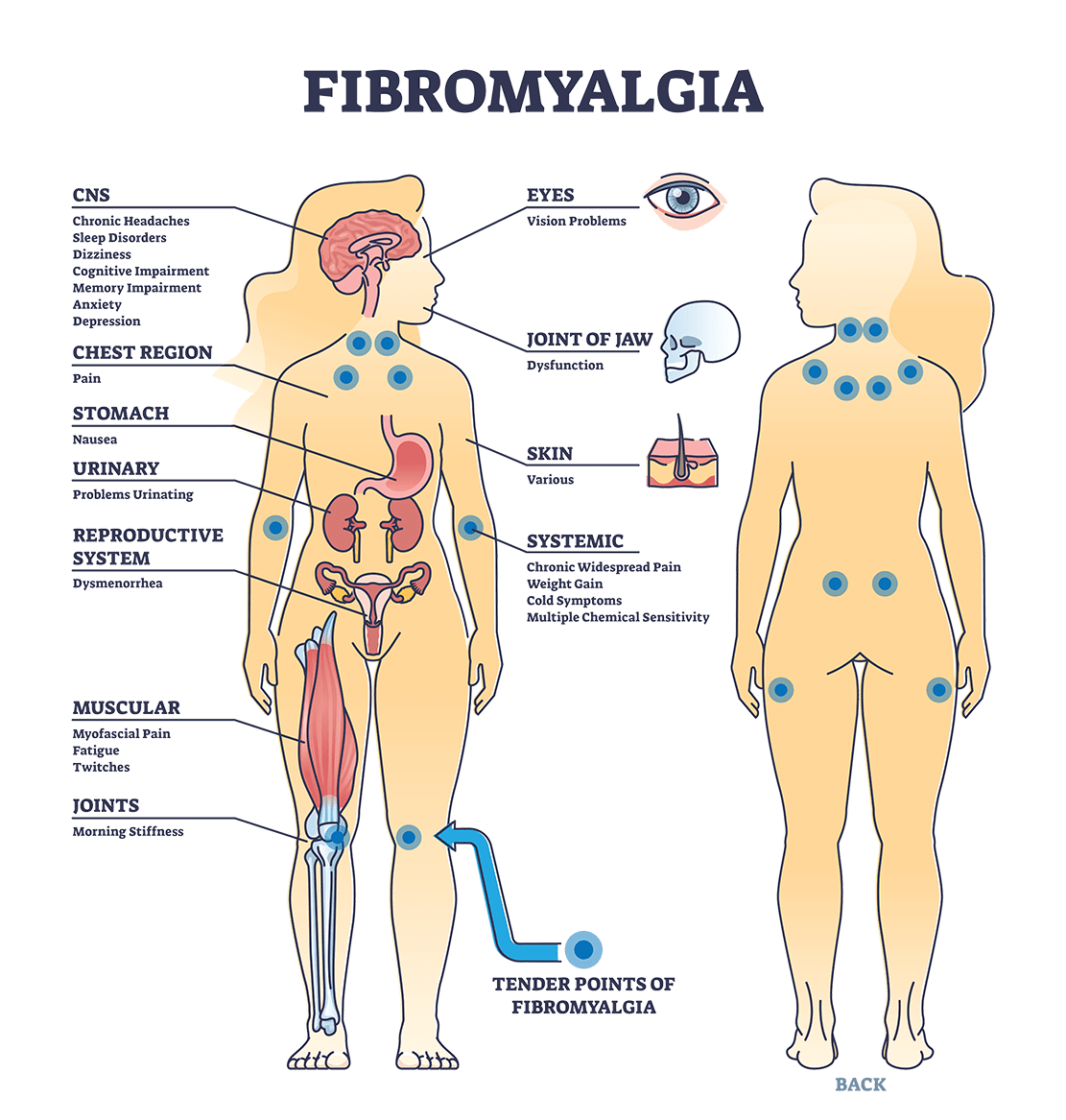 Fibromyalgia infographic